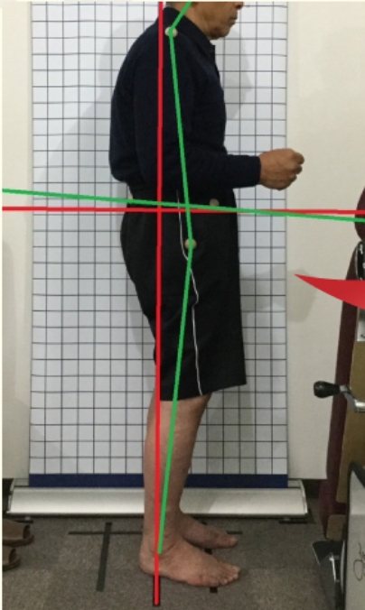 70代女性の施術前の姿勢