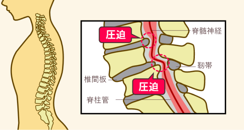 脊柱管狭窄症が神経を圧迫する仕組み