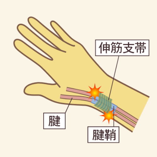 ド・ケルバン病の患部図