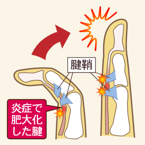 ばね指の患部図
